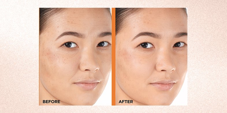 InArticlehowtogetclearskinDerm Intensives Vit C E Salicylic Acid Serum